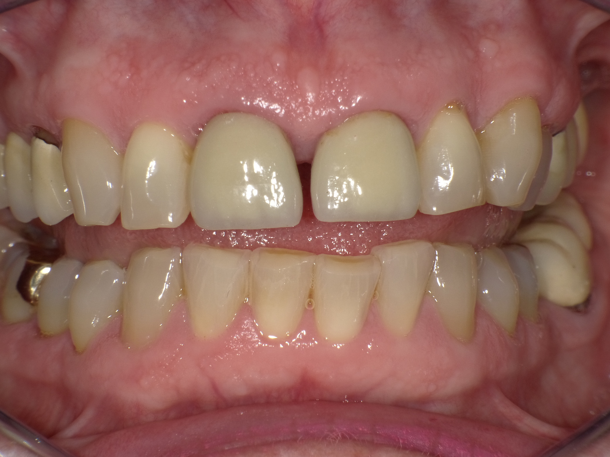 Abgesunkene Bisslage mit Lückenbildung in der Front; Wunsch des Patienten nach ästhetischer Verbesserung; Angstpatient